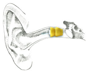 Phonak Lyric Invisible Hearing Aid In Place